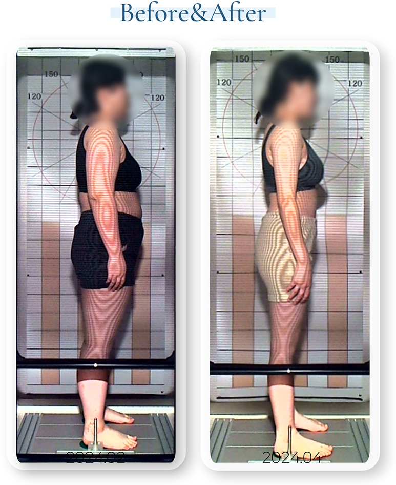 뇌움한의원의 산후 다이어트 프로그램을 통해 2024년 2월과 4월 두 달 사이에 체중 및 체형 변화가 나타난 여성의 Before & After 측면 사진. 체형의 개선과 산후 비만 해소 효과를 시각적으로 보여줌.